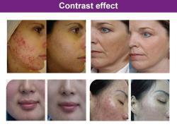 Аппарат для фототерапии с LED 630nm 430nm (арт. 25-19081622)