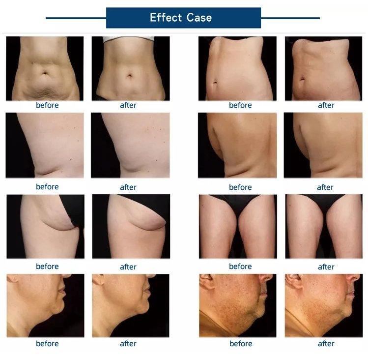 Машина для коррекции фигуры с роликом против целлюлита ABS (арт. 25-19081912)